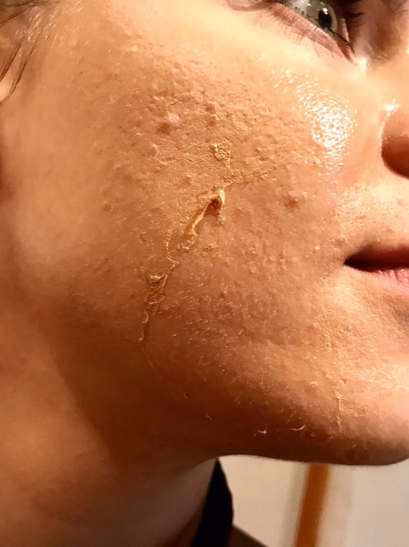 Welche Schichten der Haut werden bei einem sanften Peeling erreicht?