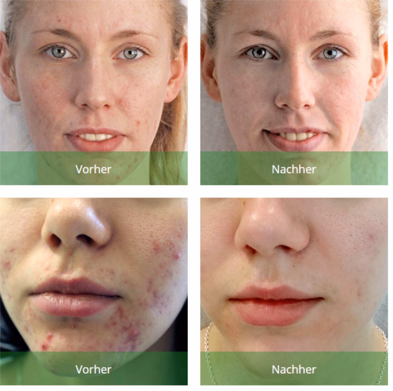Welche Schichten der Haut werden bei einem sanften Peeling erreicht?