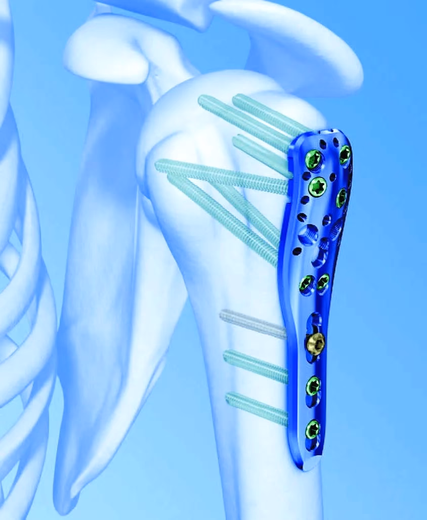 Kann man nach einem Schulterbruch noch Sport machen?