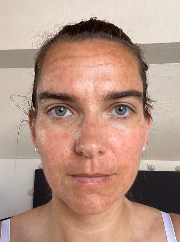 Wie wirkt sich Solarium auf die Haut aus?