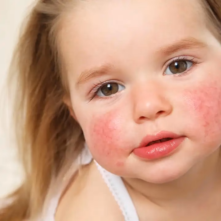 Kann man eine Sonnenallergie wieder loswerden?