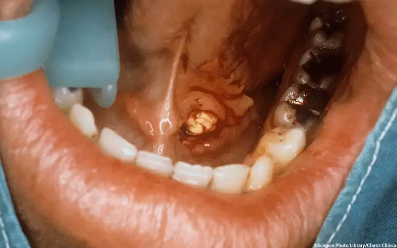 Was sind die häufigsten Erkrankungen der Speicheldrüsen?