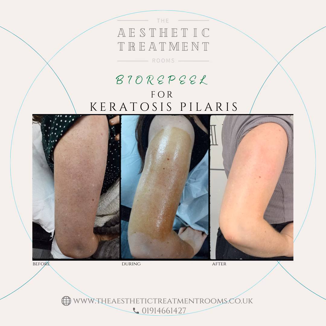 What is trichloroacetic (TCA) kojic?