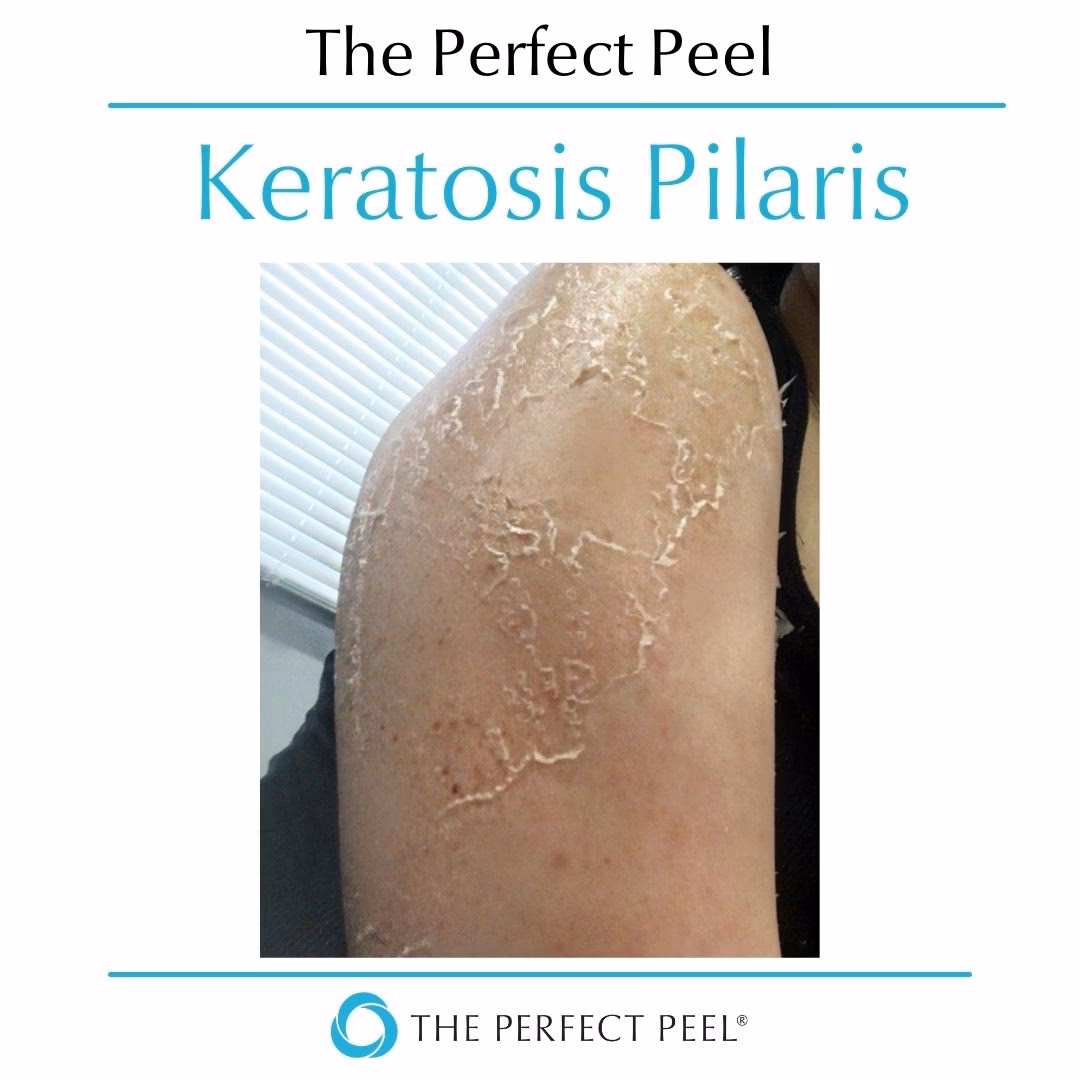 Can tetracycline be used to treat keratosis pilaris?