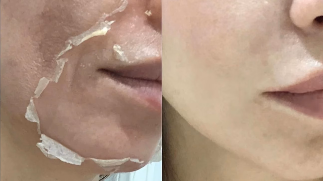 What is the difference between a TCA Peel and a resurfacing Peel?