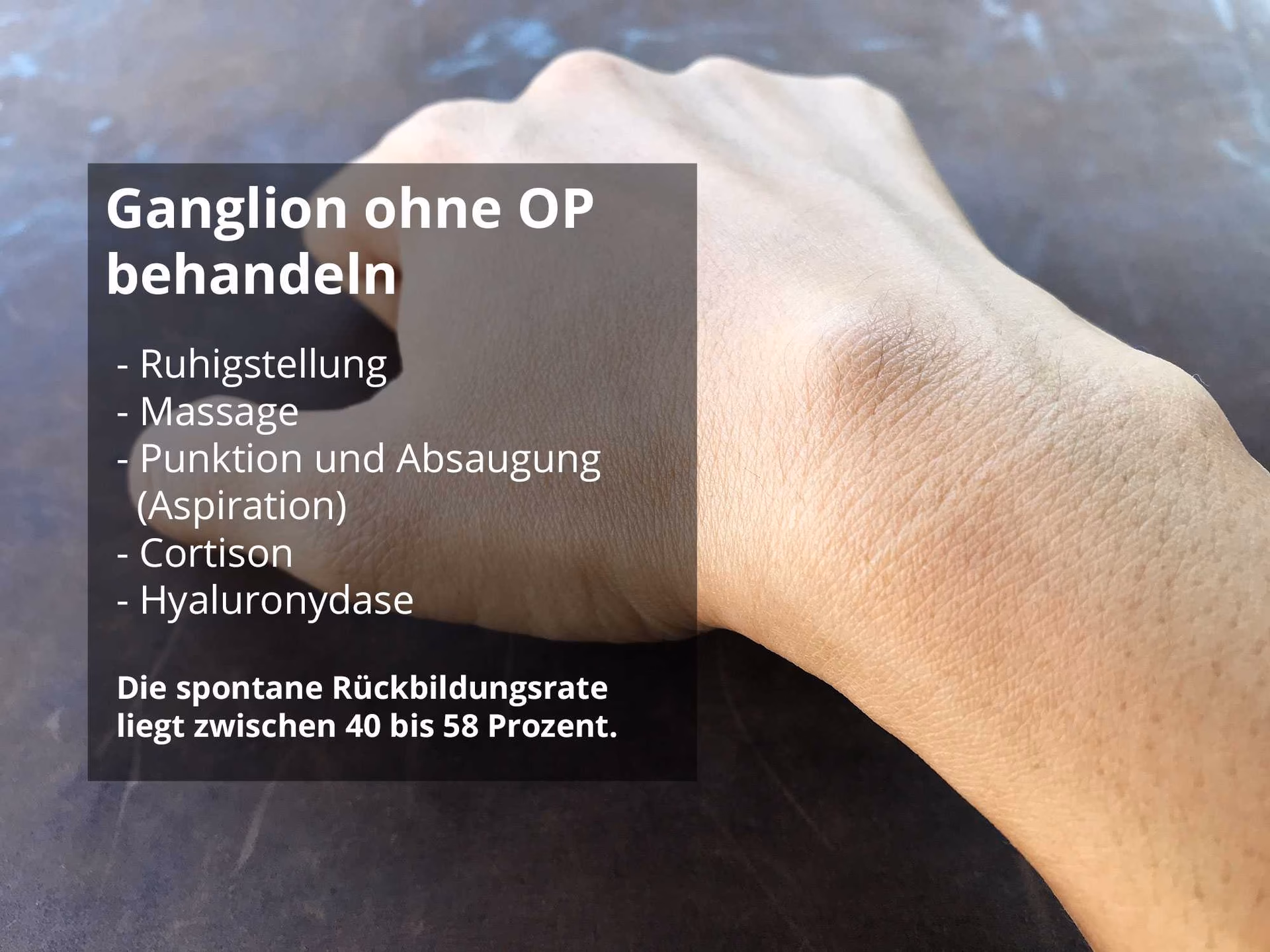 Wie sieht ein Überbein an der Hand aus?