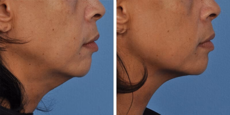 Was sind die Vorteile von Ultraschall-Behandlungen im Gesicht?