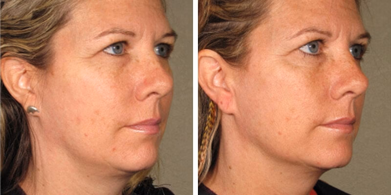 Wie funktioniert eine Ultraschallbehandlung?