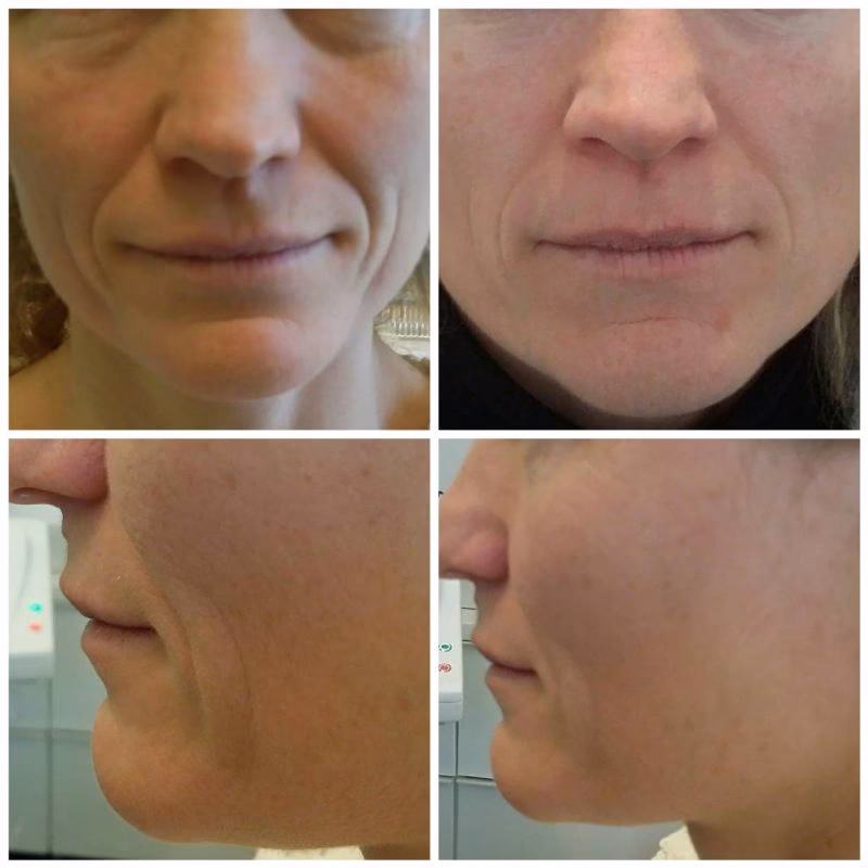 Was ist eine HIFU-Hammer-Methode?