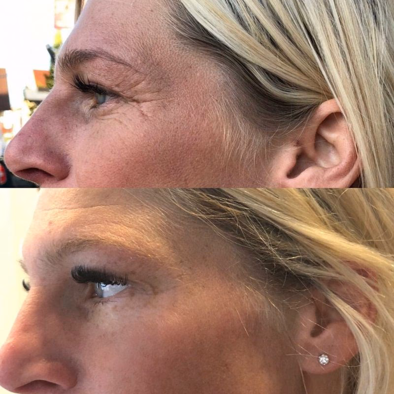 Was ist eine HIFU-Hammer-Methode?