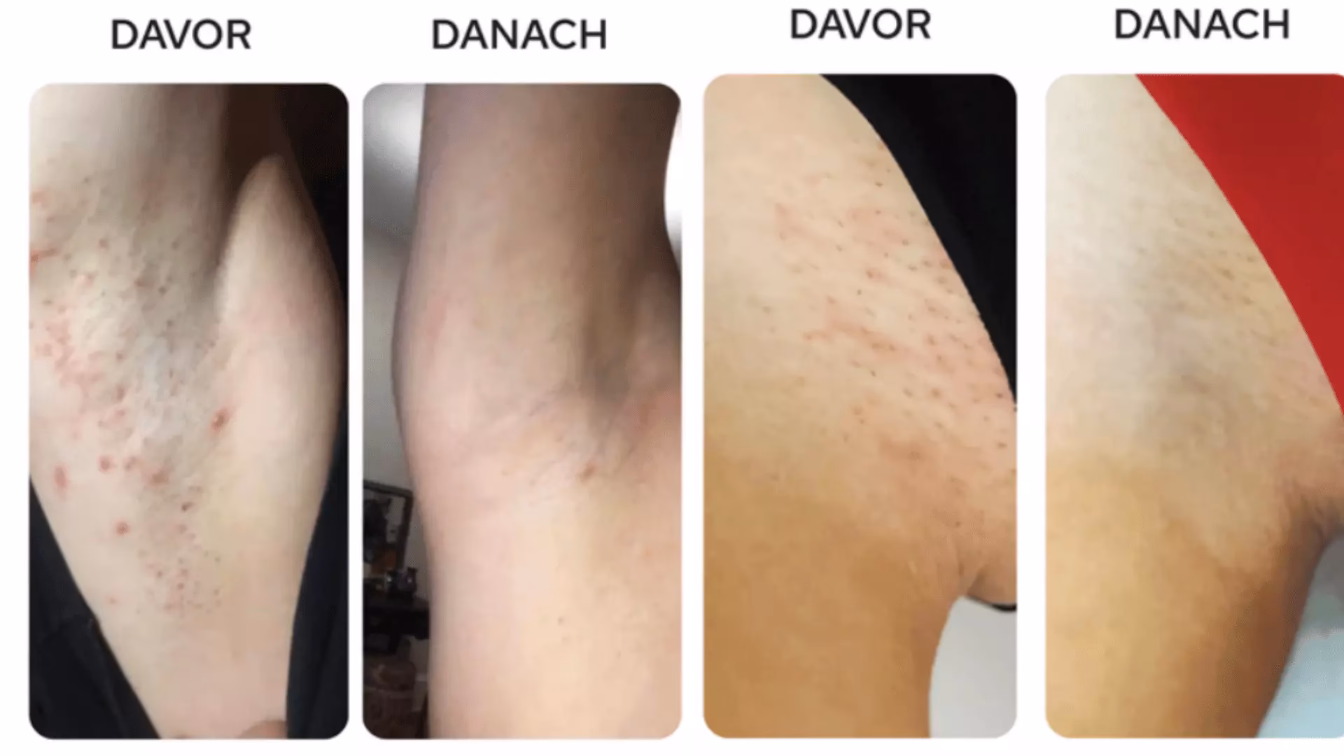 Was passiert nach der Rasur?